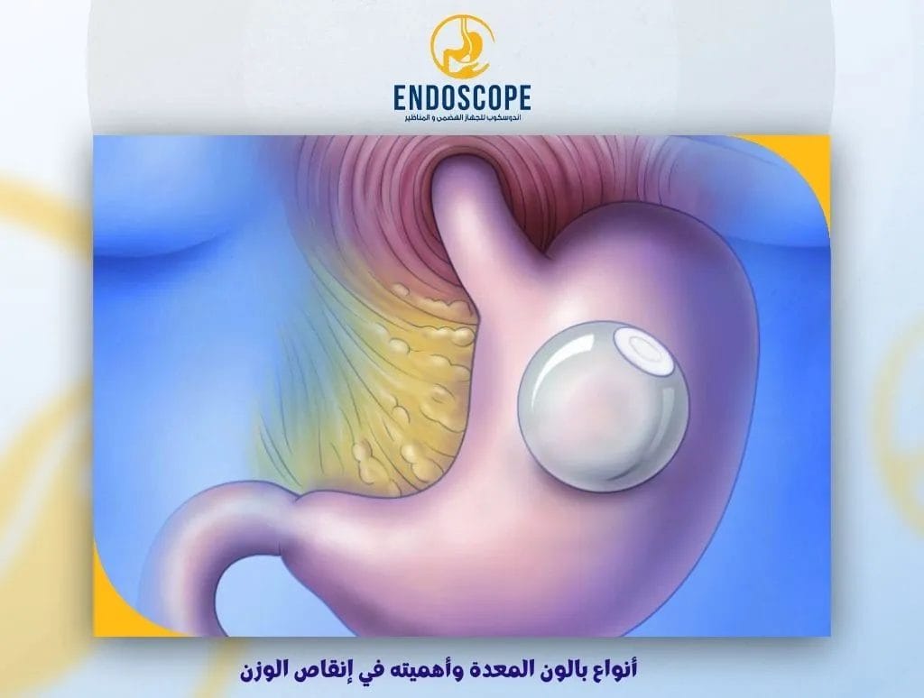 أنواع بالون المعدة وأهميته في إنقاص الوزن
