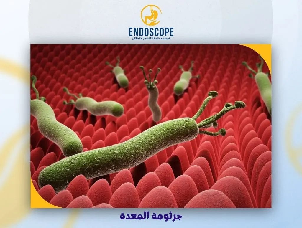 جرثومة المعدة