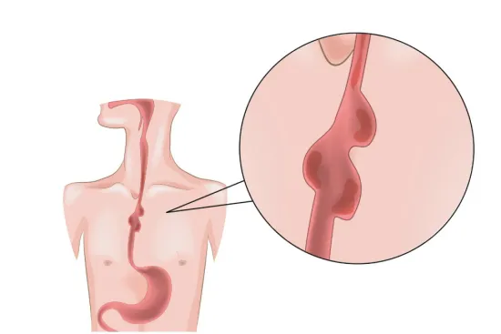 أفضل طرق علاج اضطرابات حركية المريء