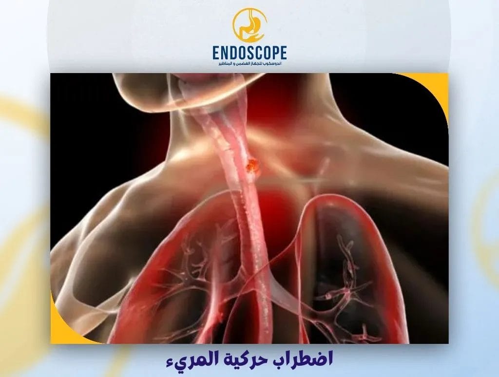 اضطراب حركية المريء