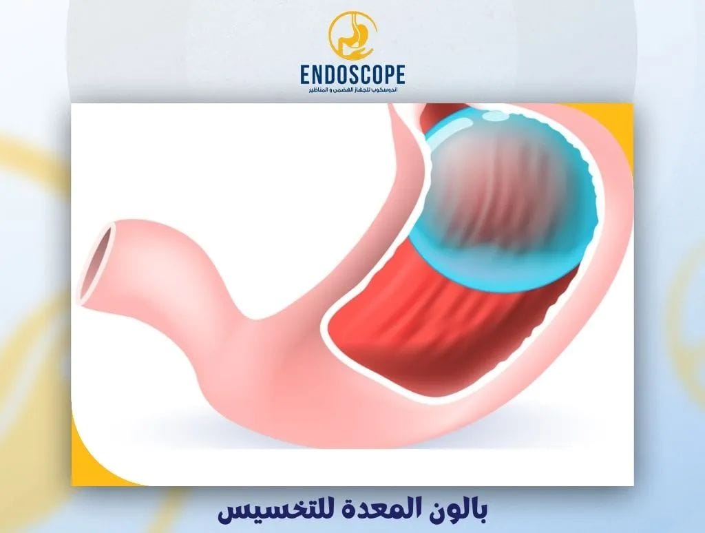 بالون المعدة للتخسيس