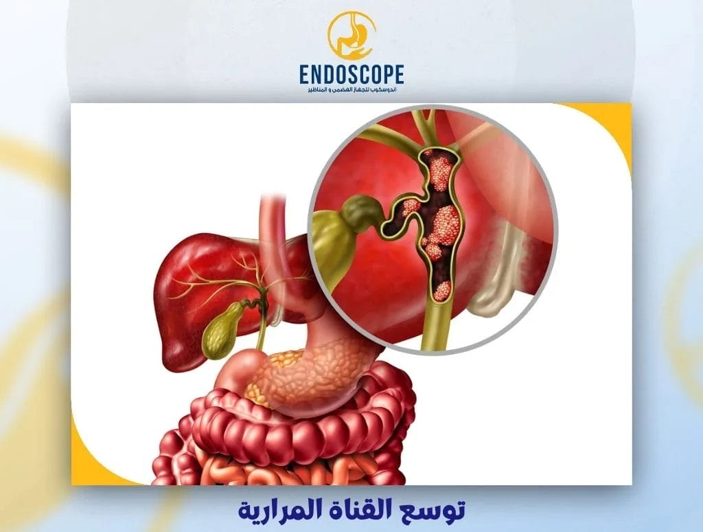 توسع القناة المرارية