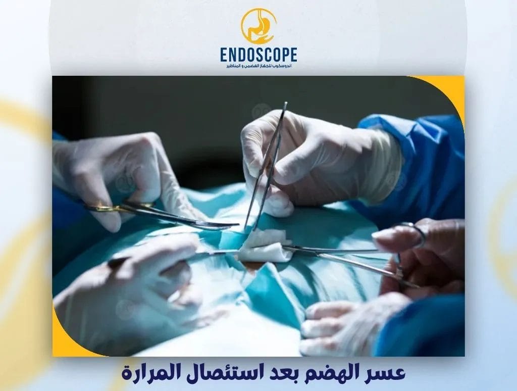 عسر الهضم بعد استئصال المرارة