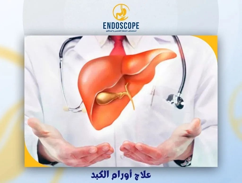 علاج أورام الكبد