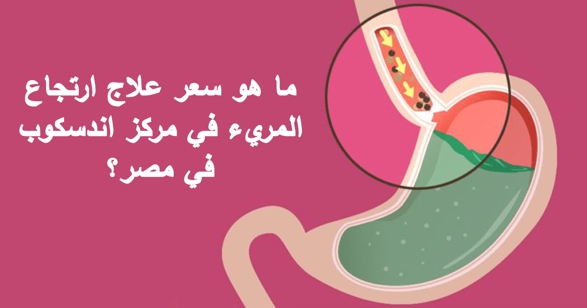 ما هو سعر علاج ارتجاع المريء في مركز اندسكوب في مصر؟