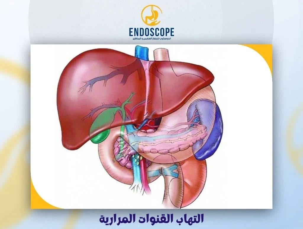 التهاب القنوات المرارية