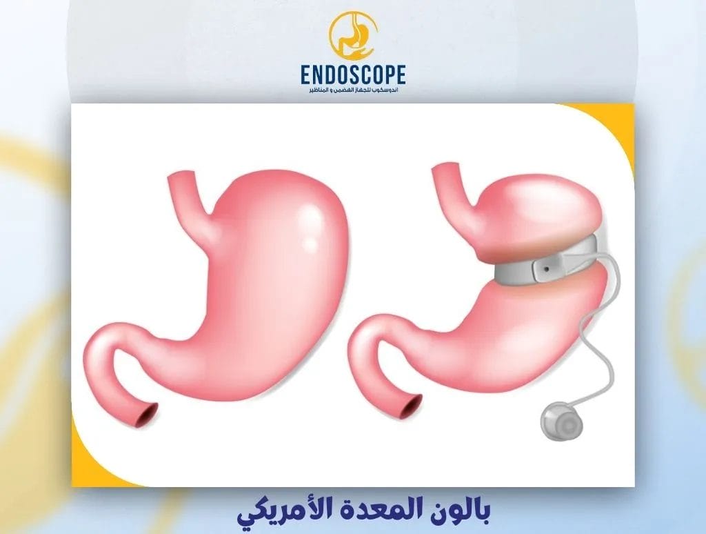 بالون المعدة الأمريكي