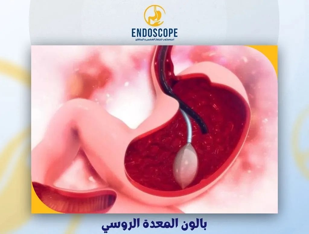 بالون المعدة الروسي