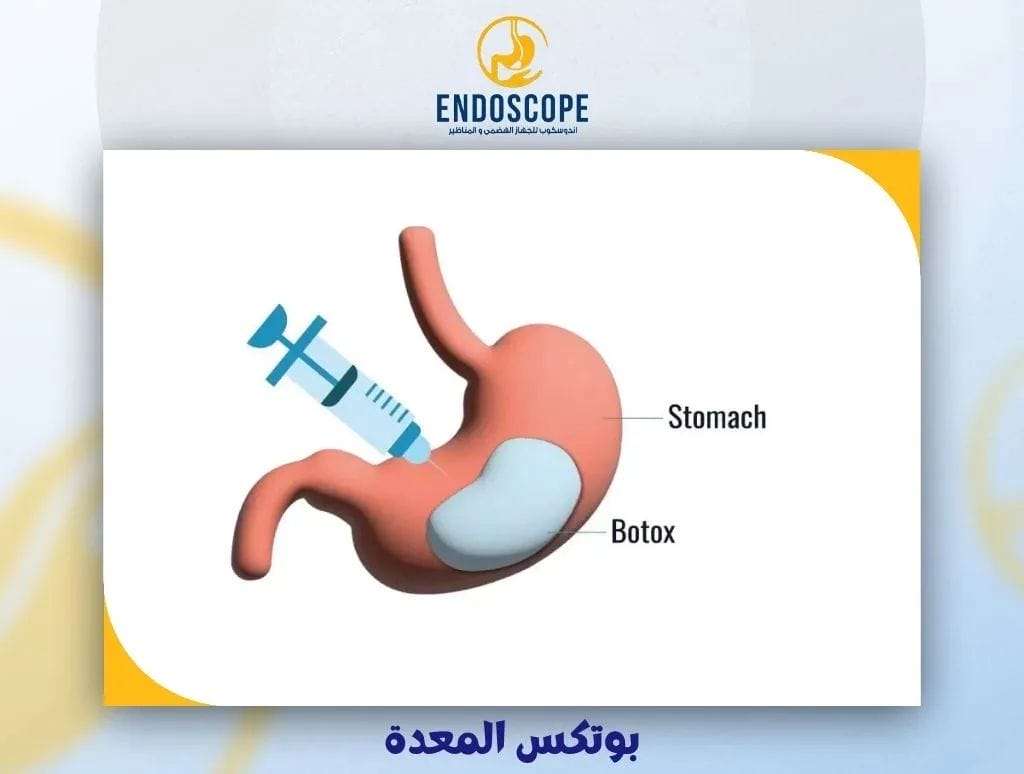 بوتكس المعدة