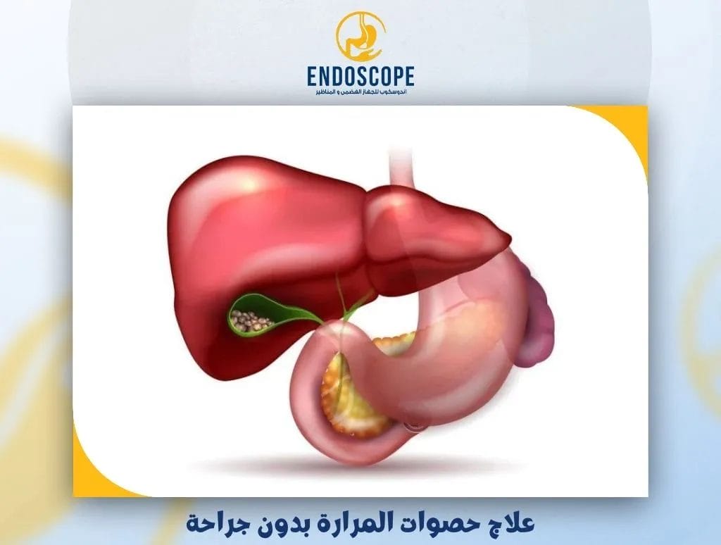 علاج حصوات المرارة بدون جراحة | أسهل طريقة لعلاج حصوة المرارة بدون جراحة