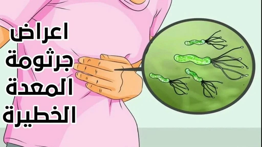 هل جرثومة المعدة تؤثر على القولون