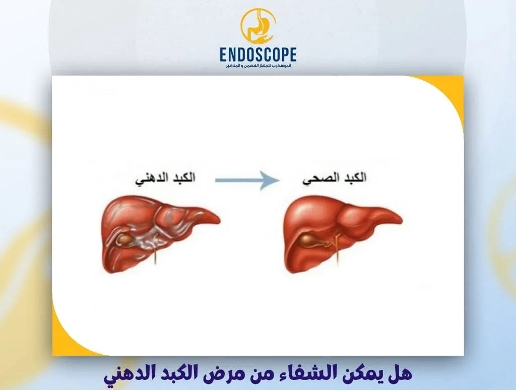 هل يمكن الشفاء من مرض الكبد الدهني