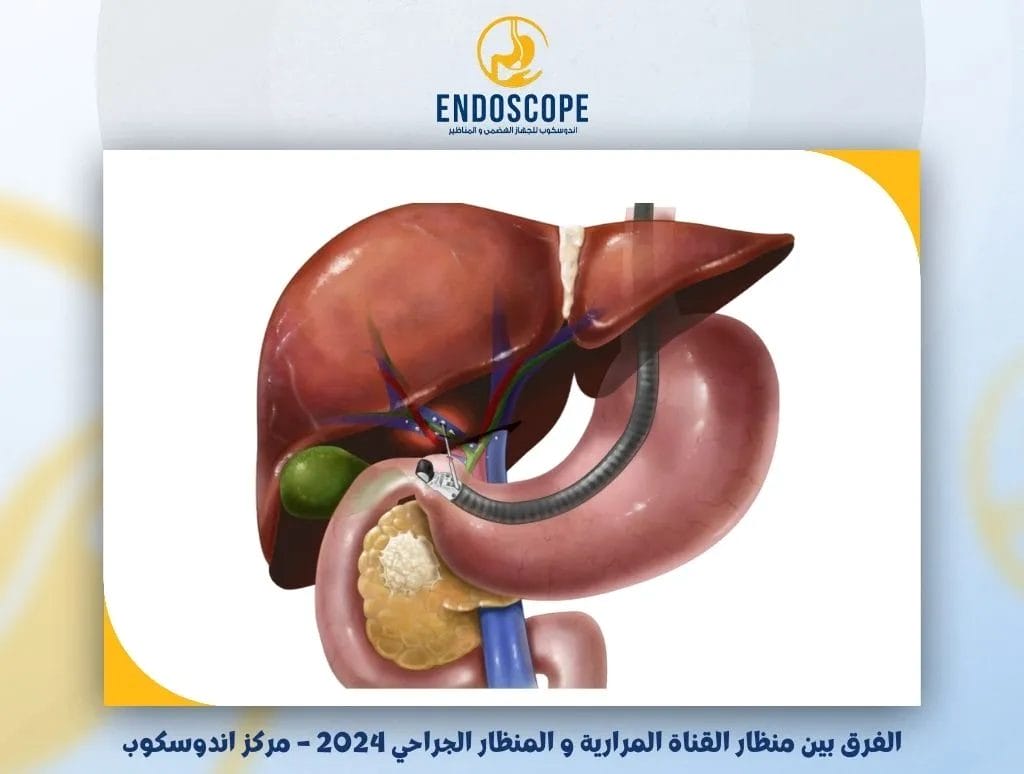 الفرق بين منظار القناة المرارية و المنظار الجراحي 2024 – مركز اندوسكوب