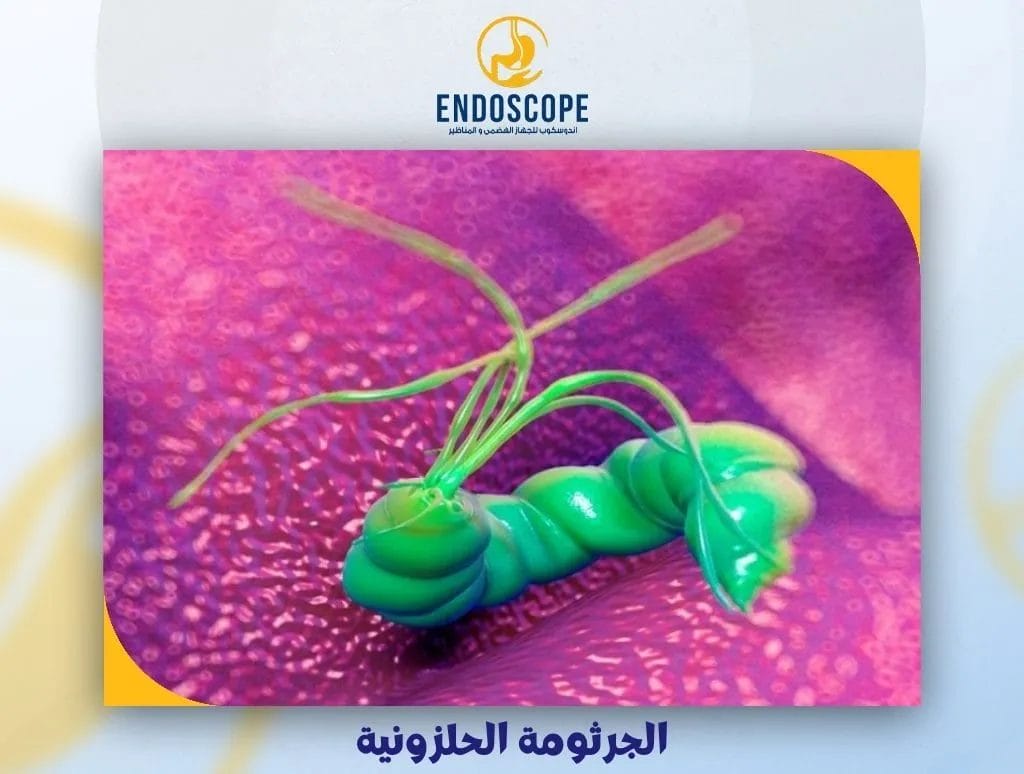 الجرثومة الحلزونية
