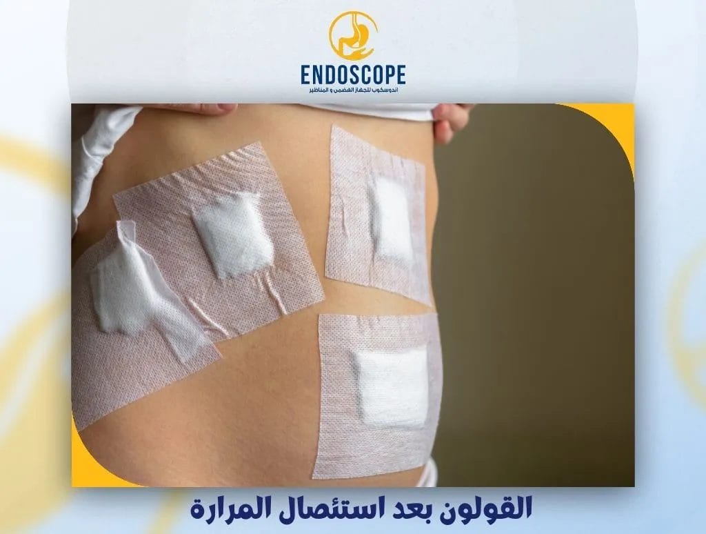 القولون بعد استئصال المرارة