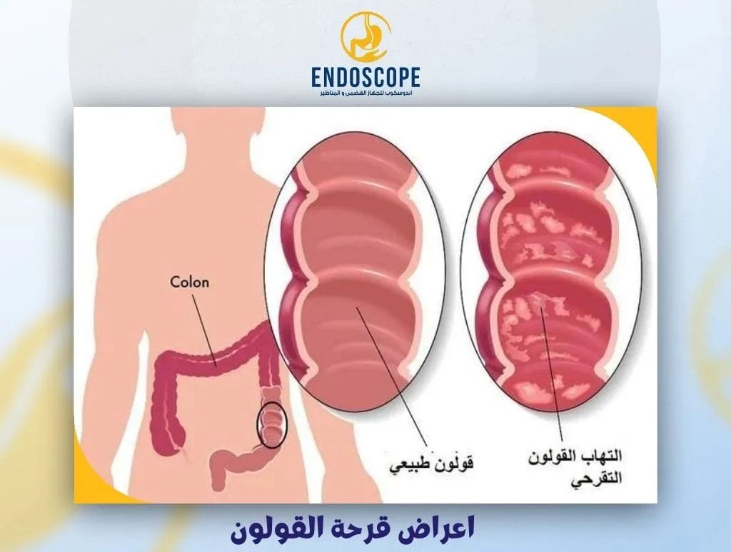 اعراض قرحة القولون