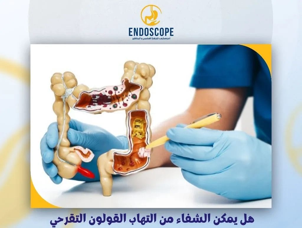 هل يمكن الشفاء من التهاب القولون التقرحي