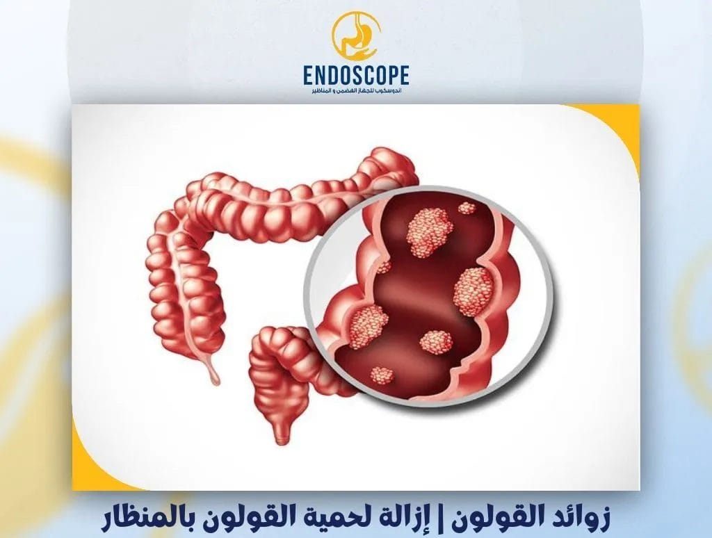 زوائد القولون | إزالة لحمية القولون بالمنظار
