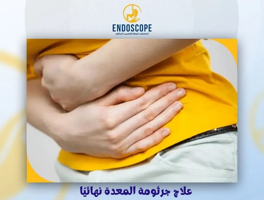 علاج جرثومة المعدة نهائيًا