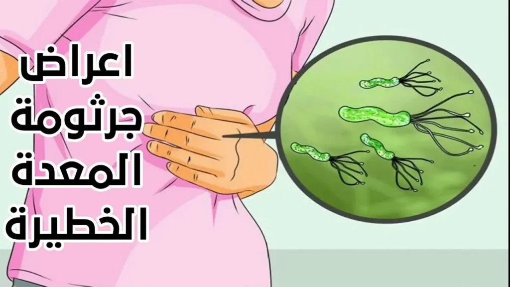 أعراض جرثومة المعدة الخطيرة