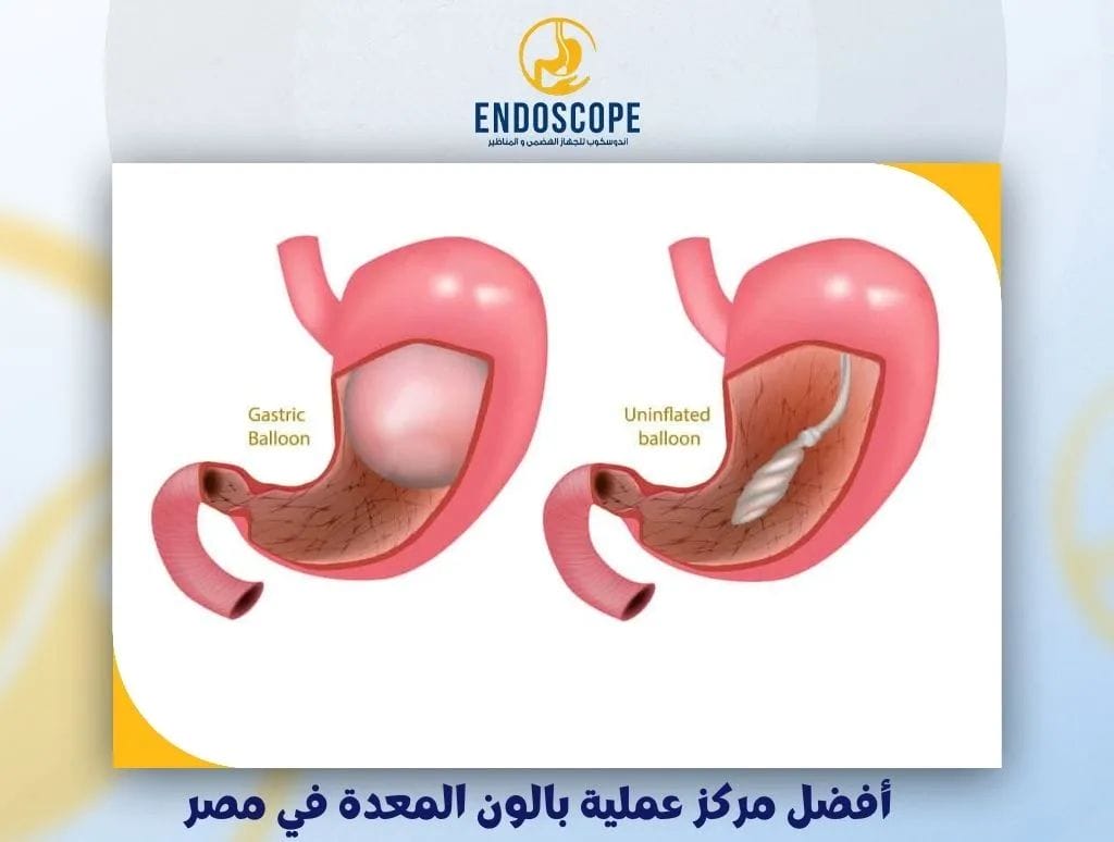 أفضل مركز عملية بالون المعدة في مصر