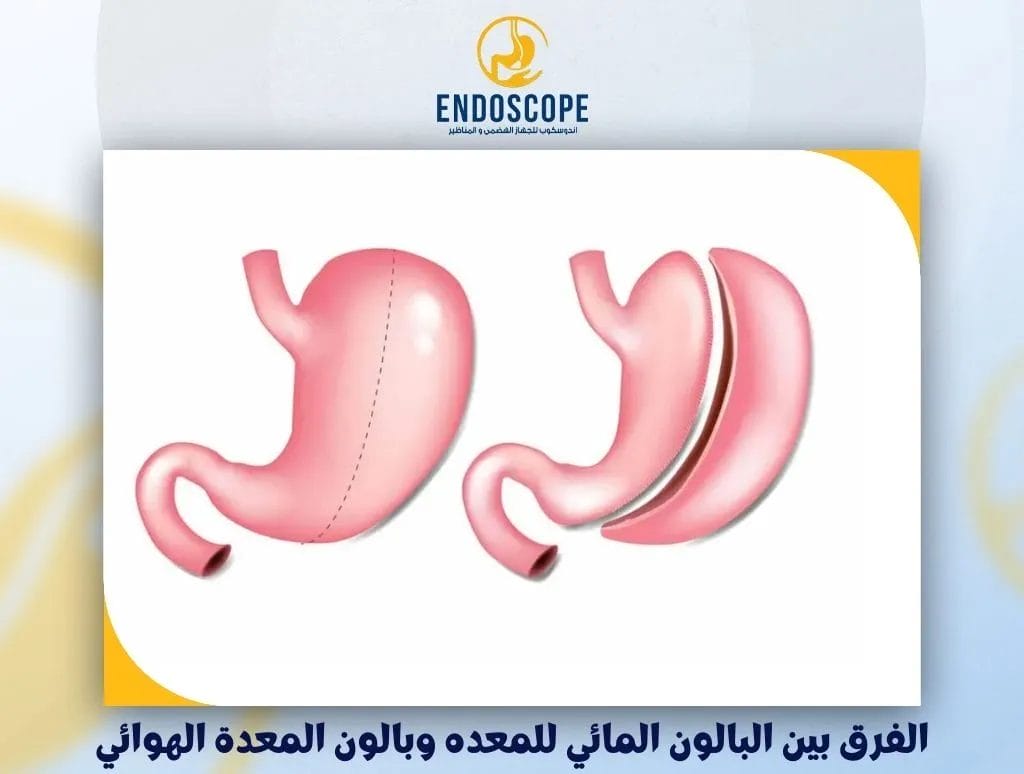 الفرق بين البالون المائي للمعده وبالون المعدة الهوائي