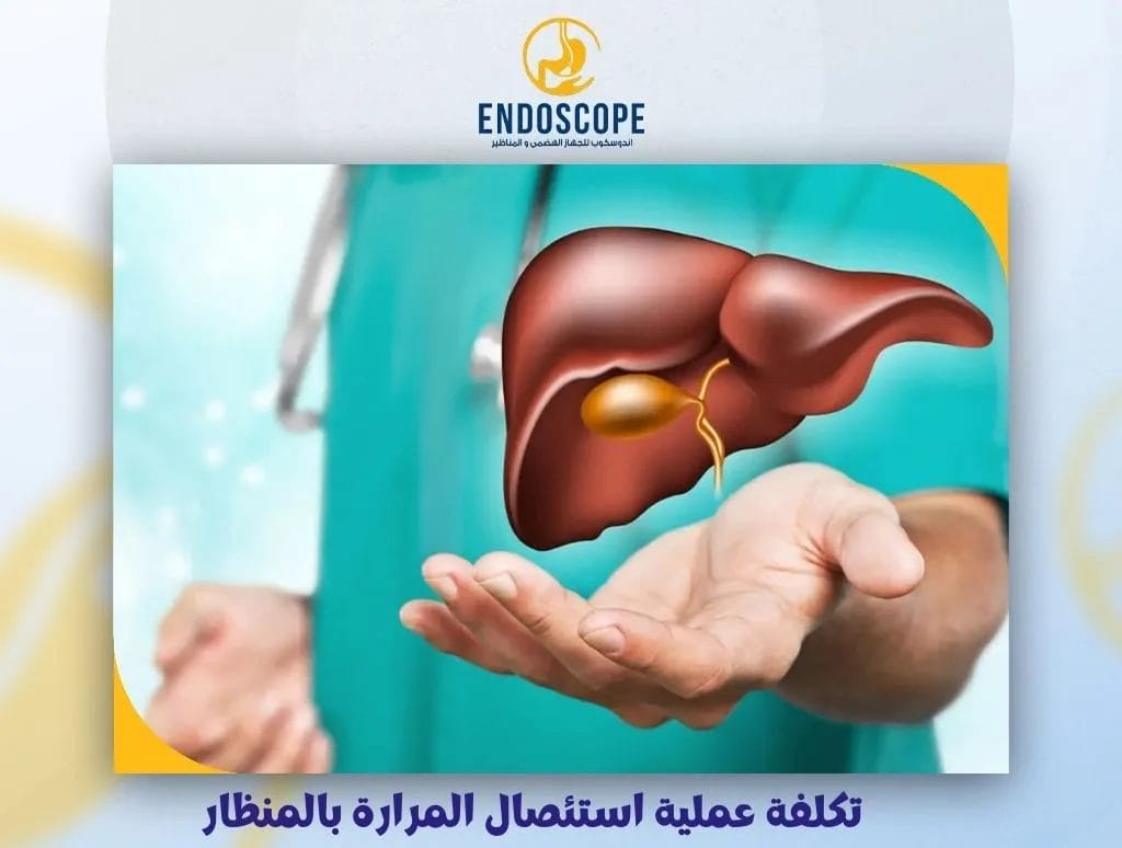 تكلفة عملية استئصال المرارة بالمنظار