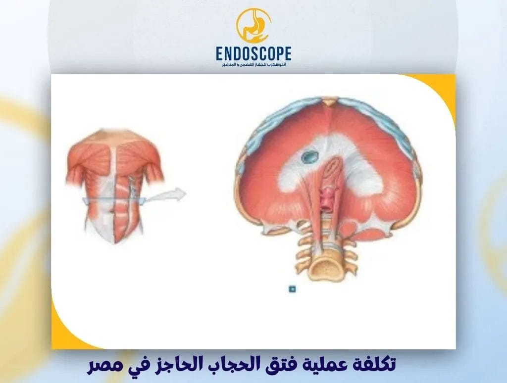 تكلفة عملية فتق الحجاب الحاجز في مصر