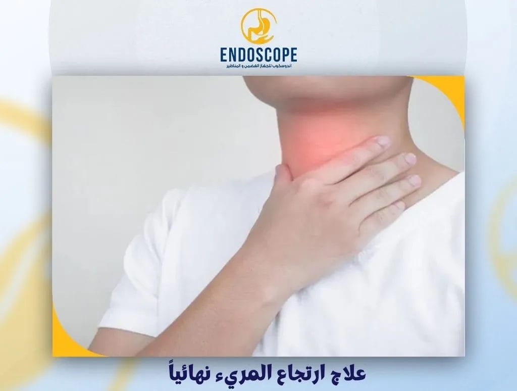 علاج ارتجاع المريء نهائياً