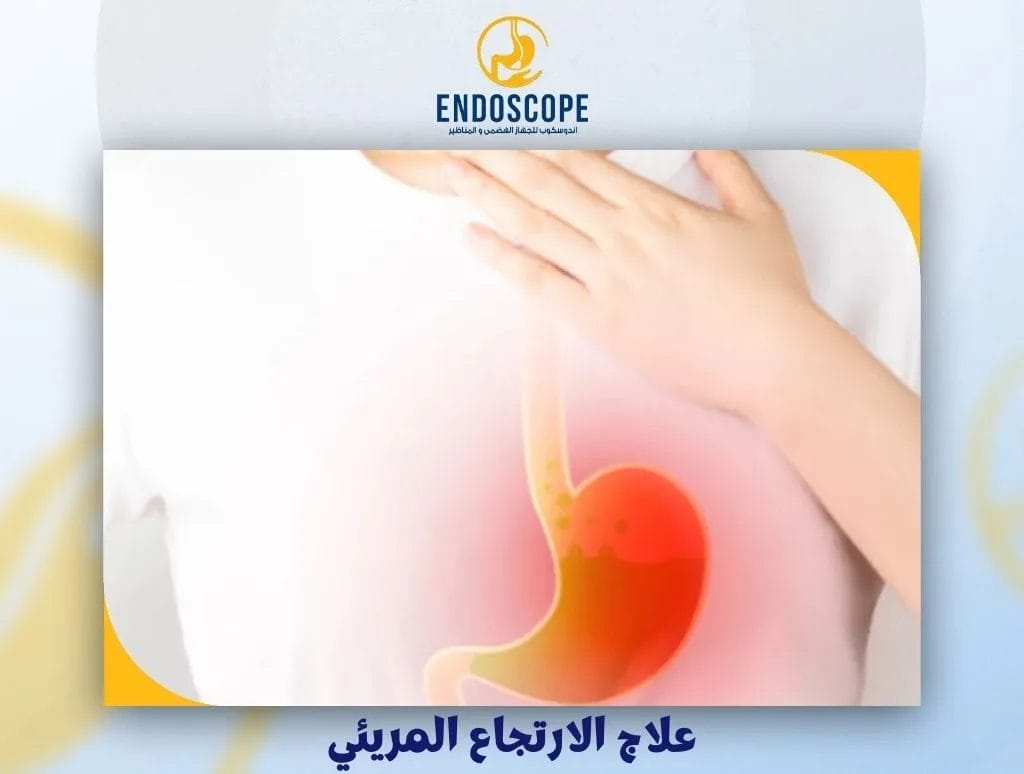 علاج الارتجاع المريئي