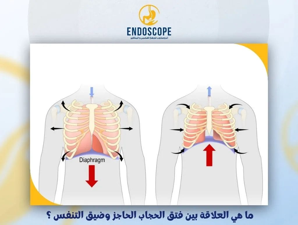 ما هي العلاقة بين فتق الحجاب الحاجز وضيق التنفس ؟