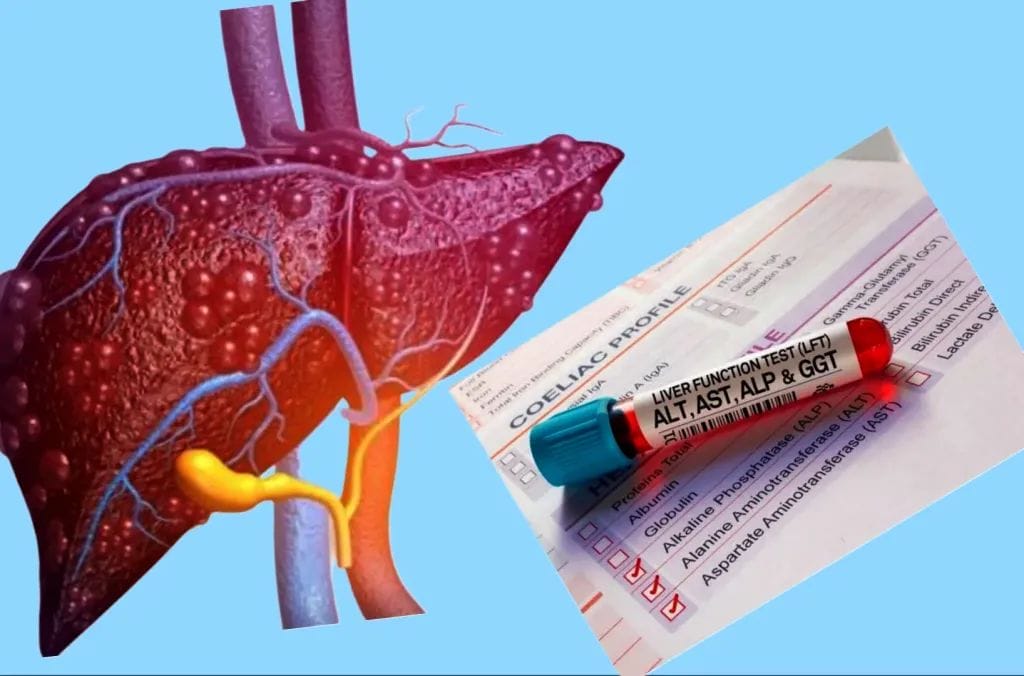 أسباب ارتفاع إنزيمات الكبد للحامل