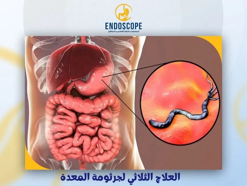 العلاج الثلاثي لجرثومة المعدة