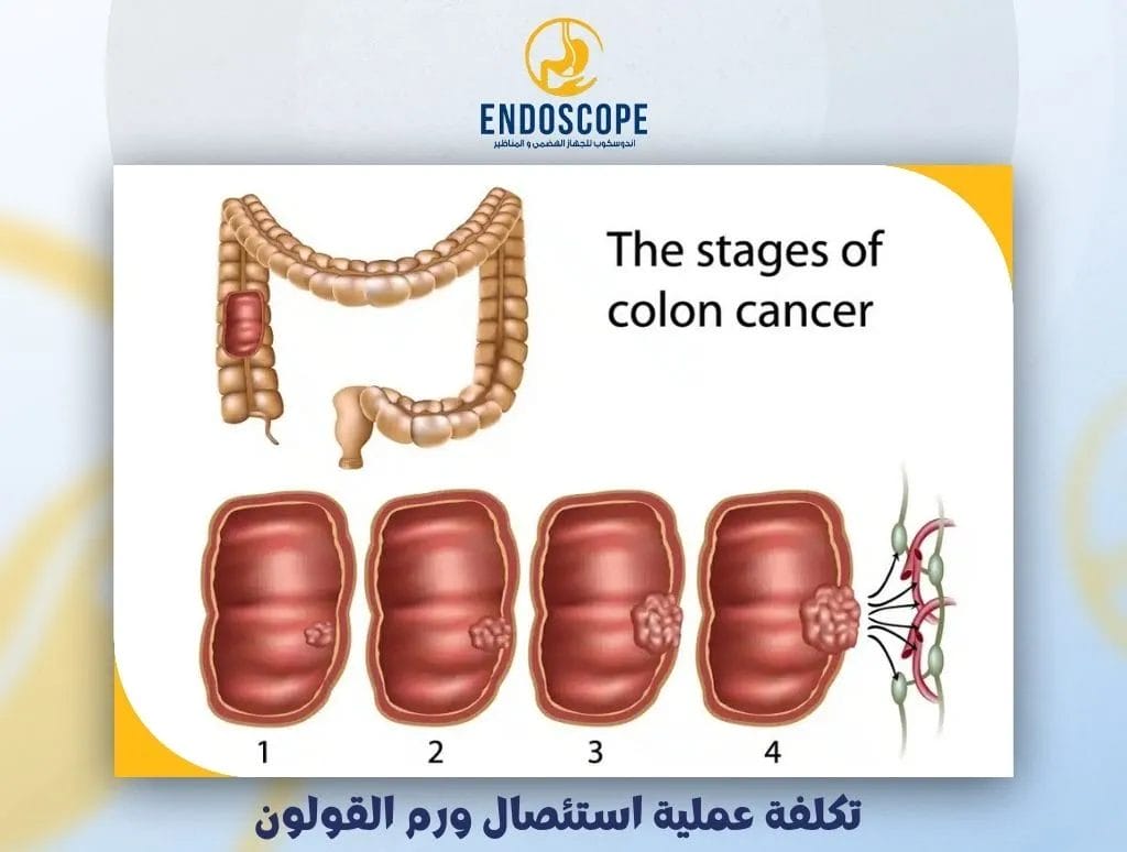 تكلفة عملية استئصال ورم القولون