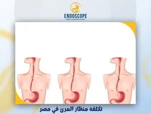 تكلفة منظار المرئ في مصر