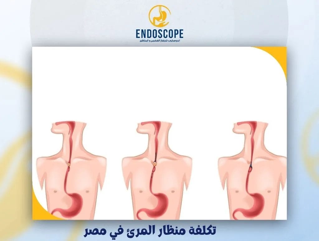تكلفة منظار المرئ في مصر