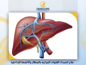 علاج انسداد القنوات المرارية بالمنظار والأشعة التداخلية