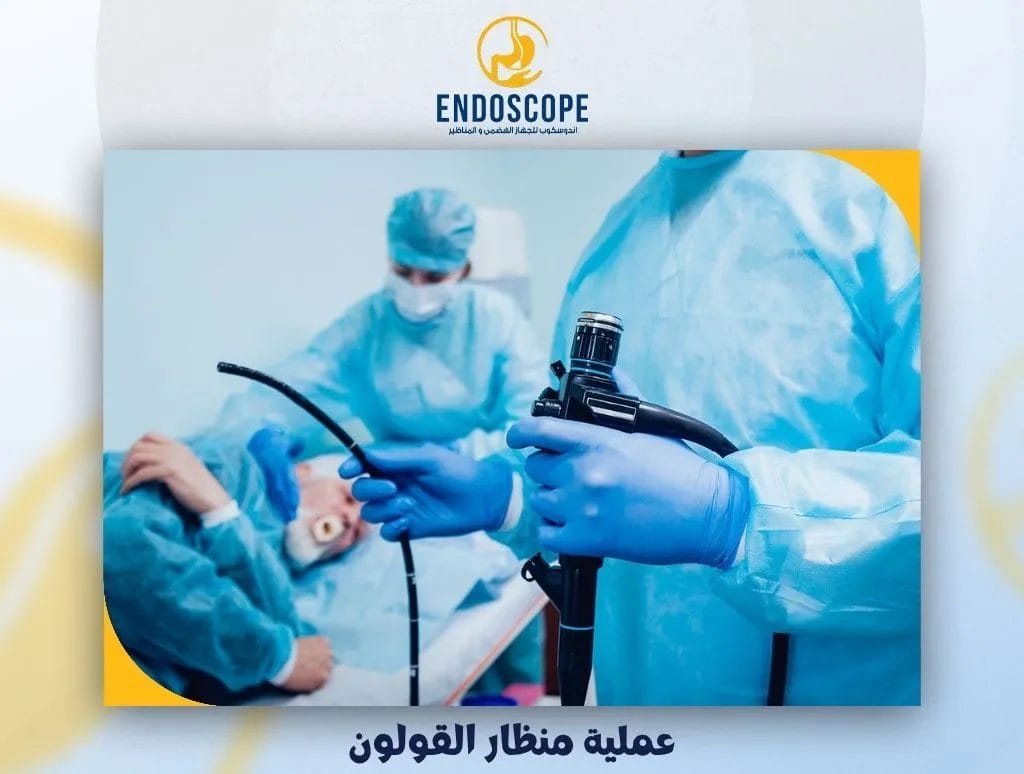 عملية منظار القولون