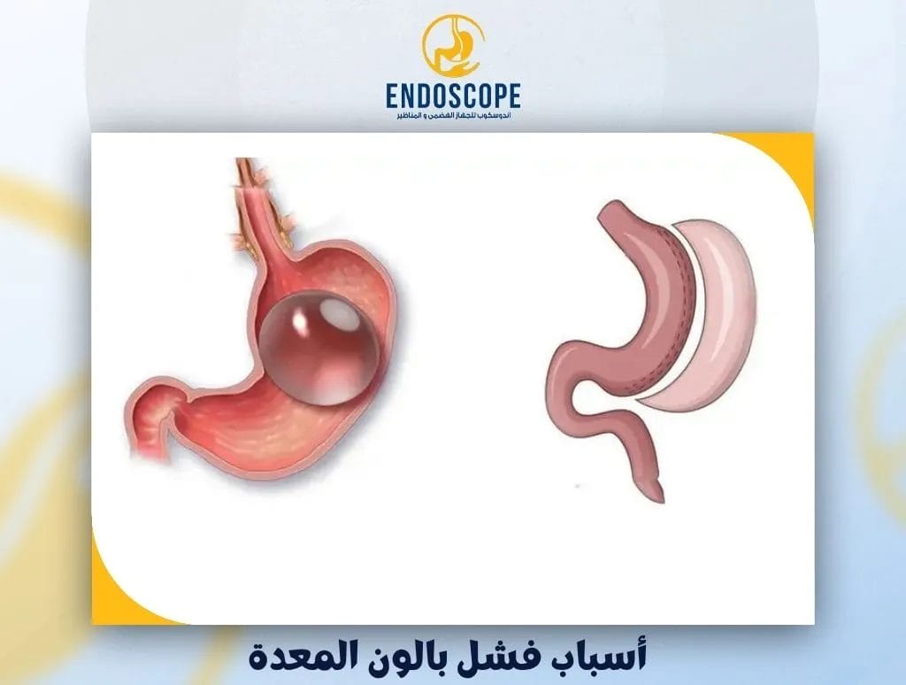 أسباب فشل بالون المعدة