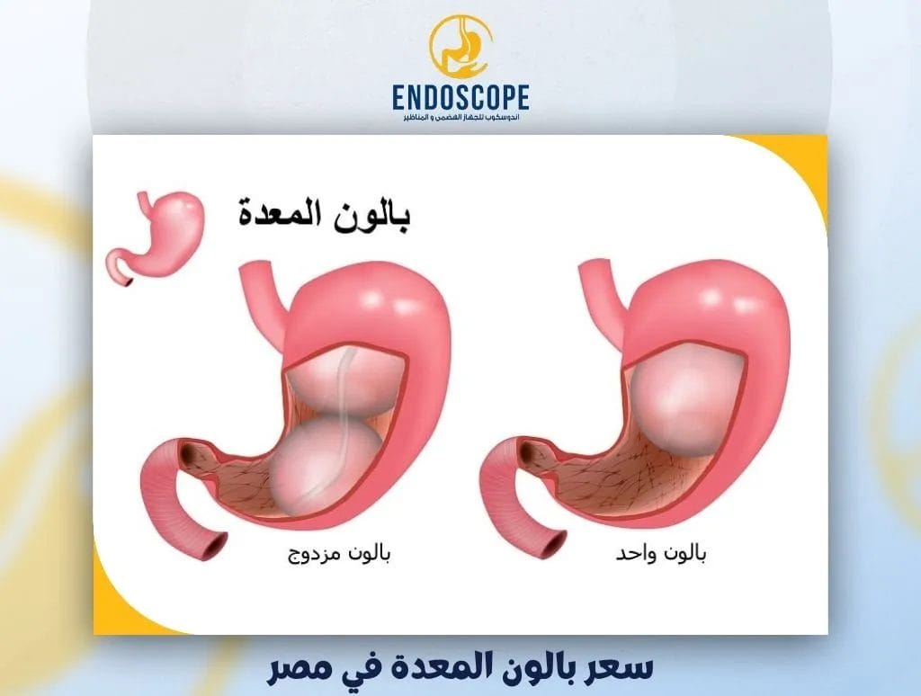 سعر بالون المعدة في مصر