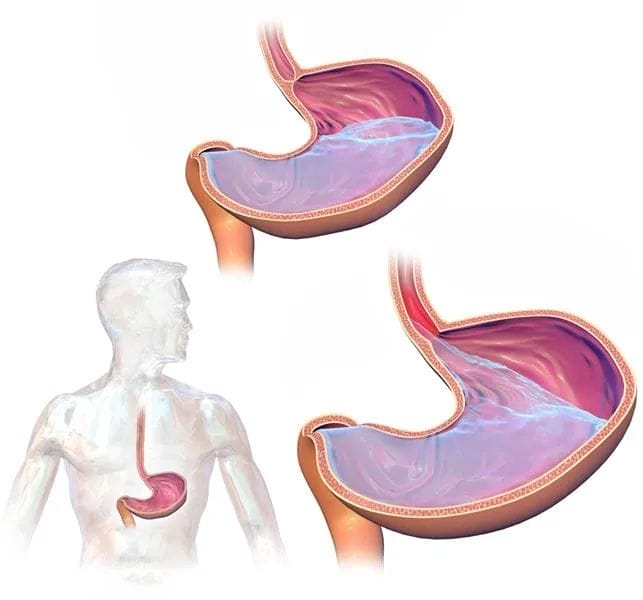 علاج ارتجاع المريء والتهاب الحلق
