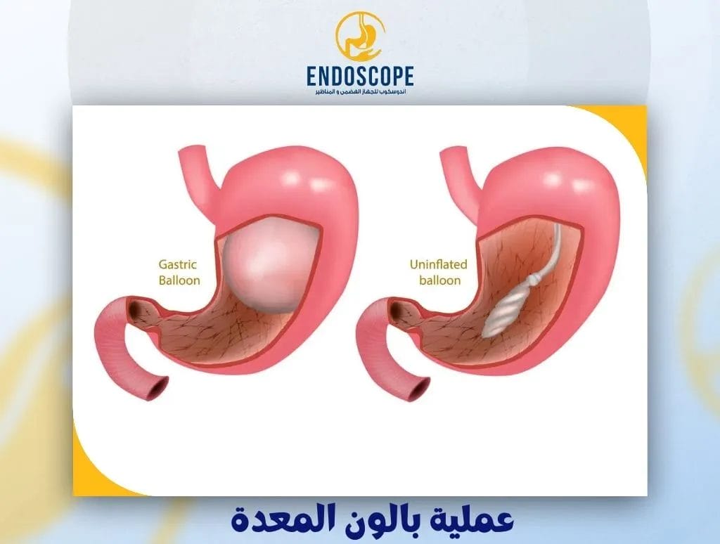 عملية بالون المعدة طريقة الإجراء، المميزات والعيوب