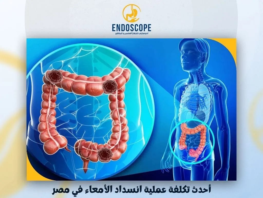 أحدث تكلفة عملية انسداد الأمعاء في مصر