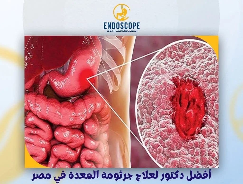 أفضل دكتور لعلاج جرثومة المعدة في مصر