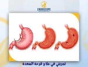 تجربتي في علاج قرحة المعدة